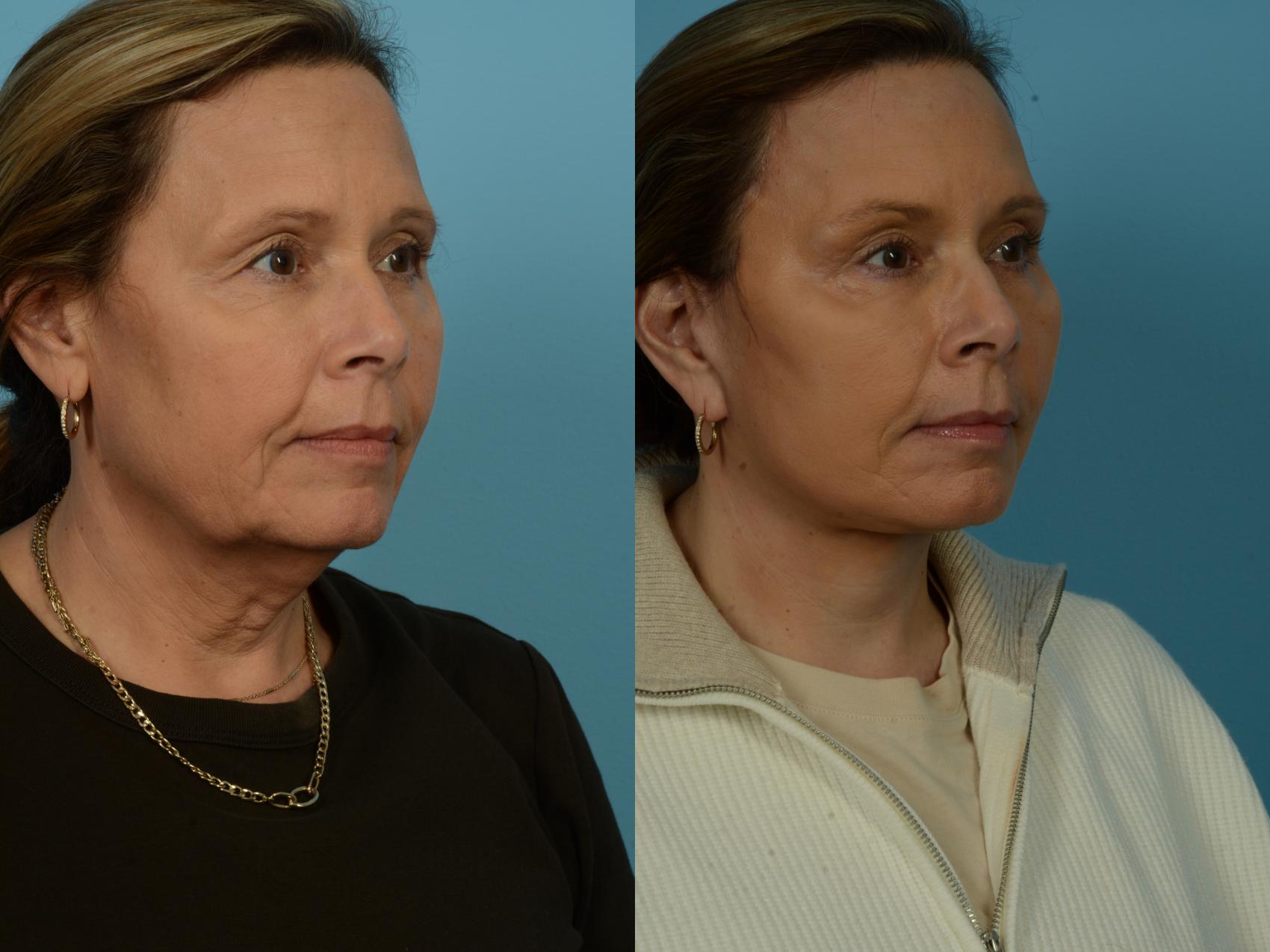 Before & After Dual Plane Facelift by Dr. Sinno Case 1122 Right Oblique View in Chicago, IL
