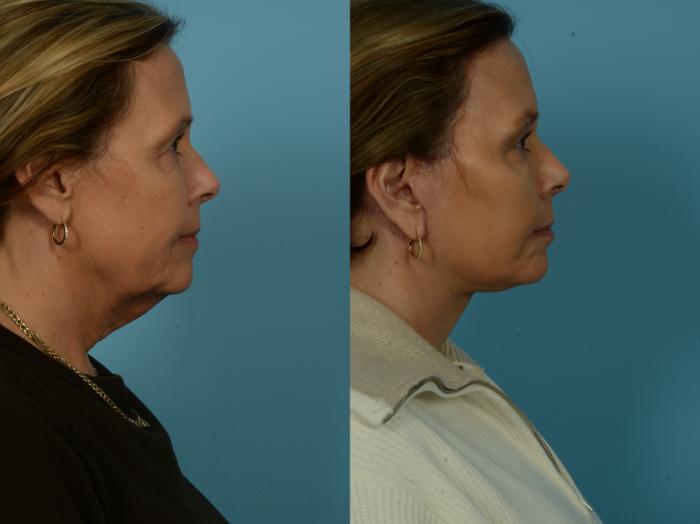 Before & After Dual Plane Facelift by Dr. Sinno Case 1122 Right Side View in Chicago, IL