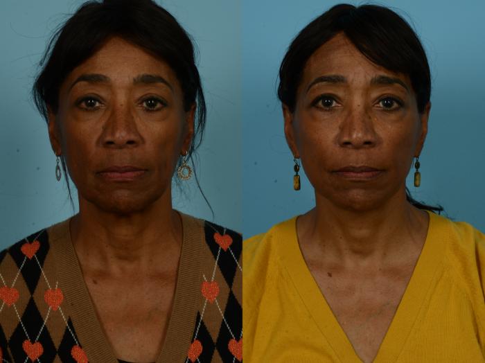 Before & After Dual Plane Facelift by Dr. Sinno Case 1127 Front View in Chicago, IL