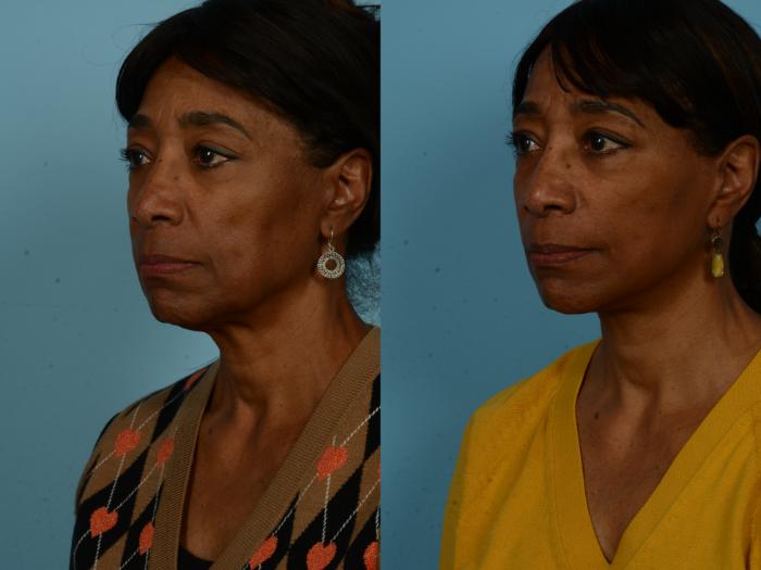 Before & After Dual Plane Facelift by Dr. Sinno Case 1127 Left Oblique View in Chicago, IL