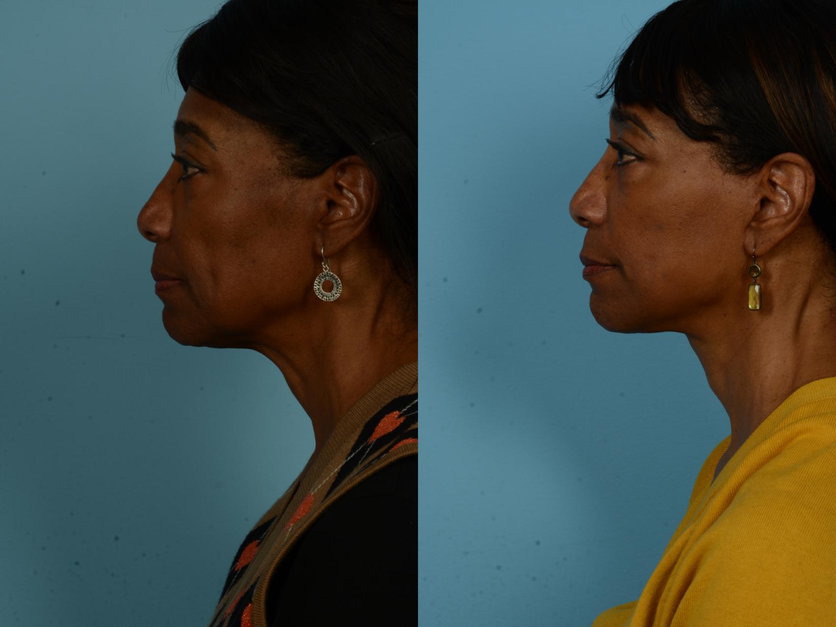 Before & After Dual Plane Facelift by Dr. Sinno Case 1127 Left Side View in Chicago, IL