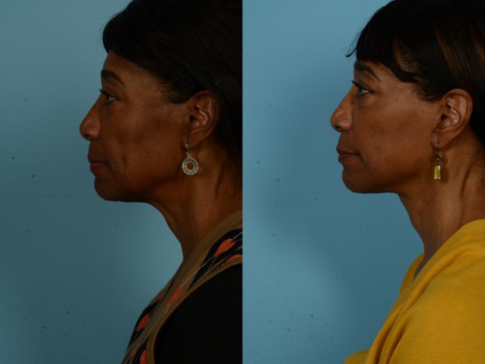 Before & After Dual Plane Facelift by Dr. Sinno Case 1127 Left Side View in Chicago, IL