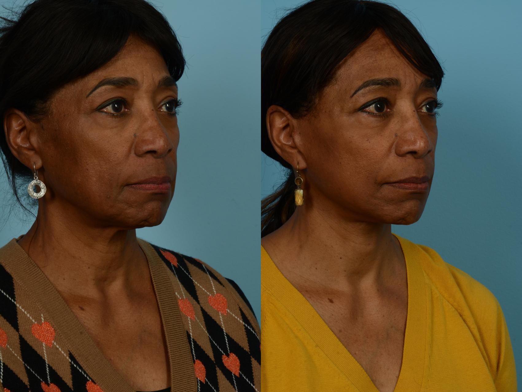 Before & After Dual Plane Facelift by Dr. Sinno Case 1127 Right Oblique View in Chicago, IL