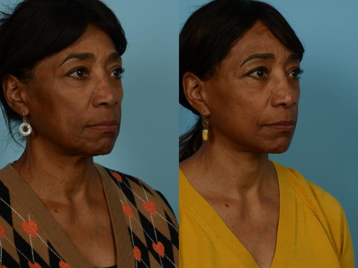 Before & After Dual Plane Facelift by Dr. Sinno Case 1127 Right Oblique View in Chicago, IL