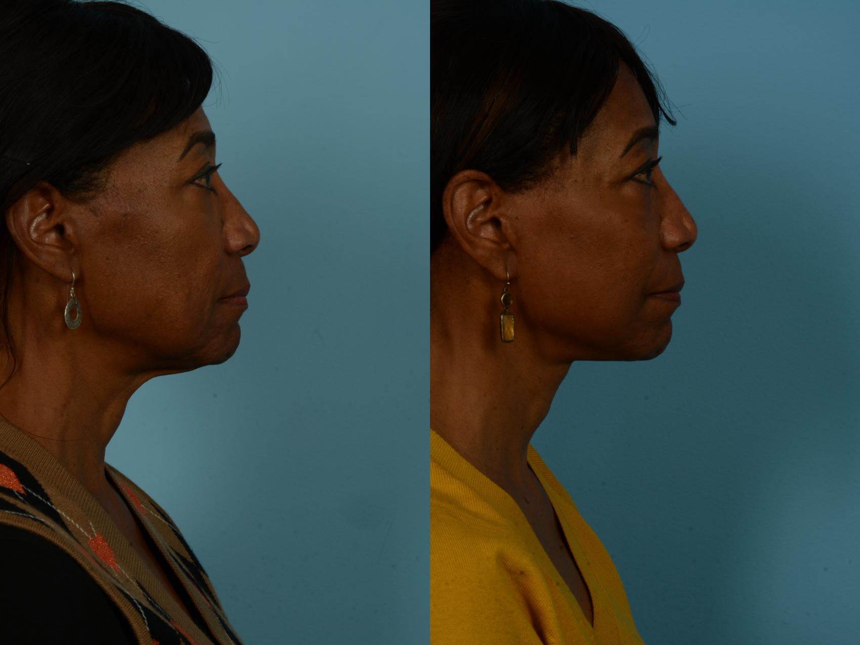 Before & After Dual Plane Facelift by Dr. Sinno Case 1127 Right Side View in Chicago, IL