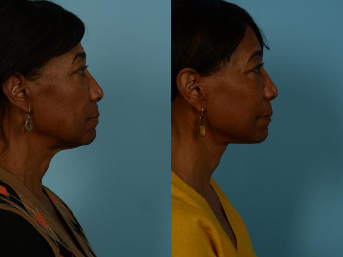 Before & After Dual Plane Facelift by Dr. Sinno Case 1127 Right Side View in Chicago, IL
