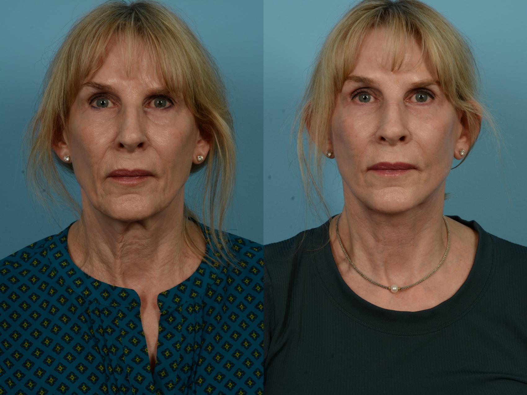 Before & After Dual Plane Facelift by Dr. Sinno Case 1137 Front View in Chicago, IL