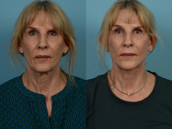 Before & After Dual Plane Facelift by Dr. Sinno Case 1137 Front View in Chicago, IL
