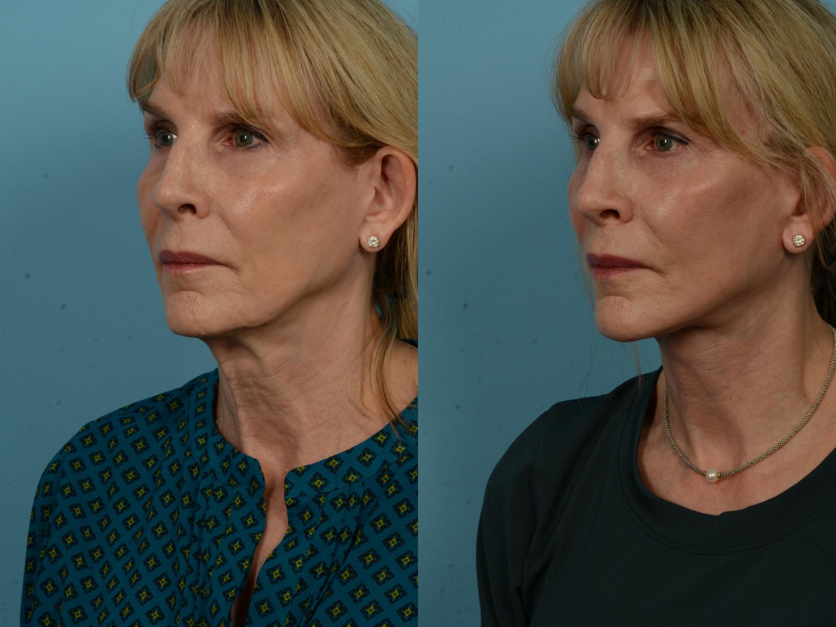 Before & After Dual Plane Facelift by Dr. Sinno Case 1137 Left Oblique View in Chicago, IL