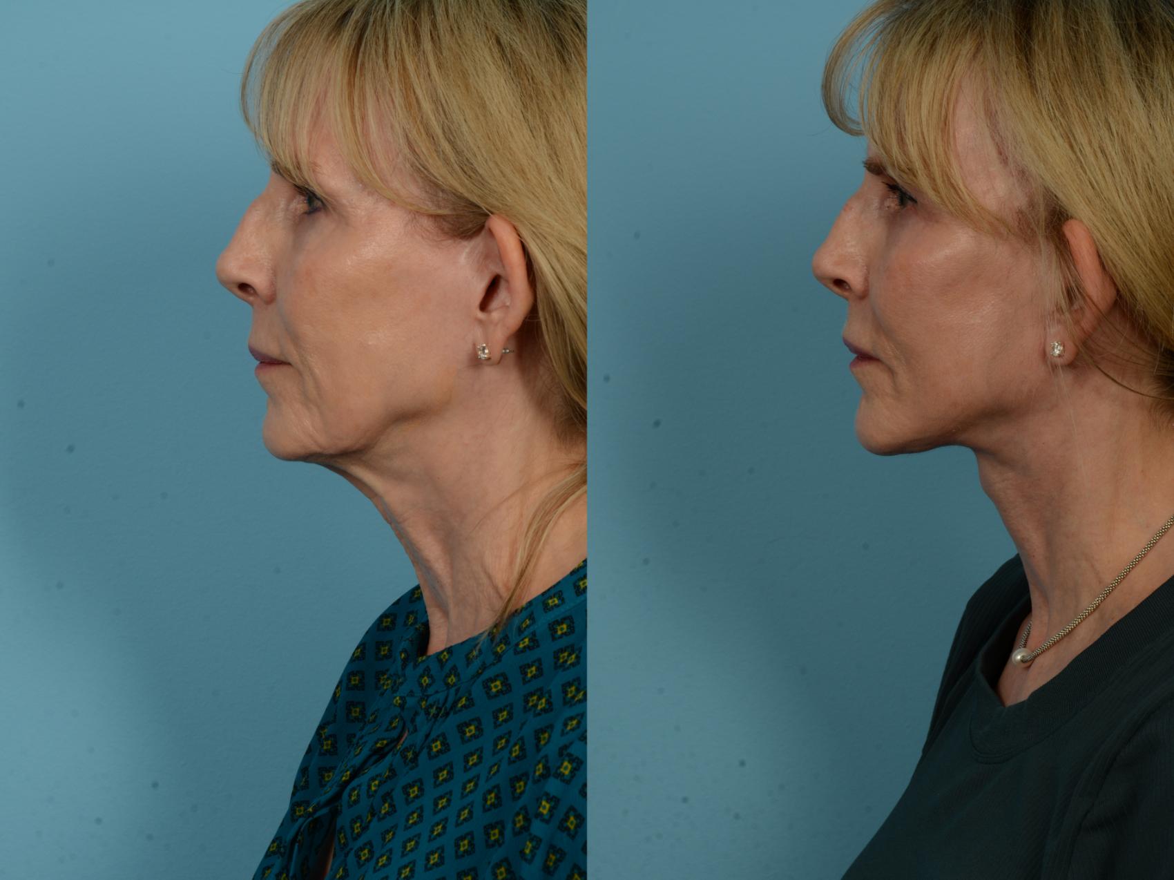 Before & After Dual Plane Facelift by Dr. Sinno Case 1137 Left Side View in Chicago, IL