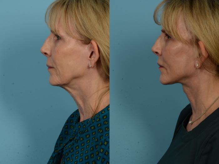Before & After Dual Plane Facelift by Dr. Sinno Case 1137 Left Side View in Chicago, IL