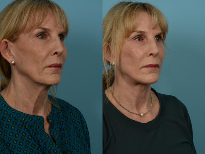 Before & After Dual Plane Facelift by Dr. Sinno Case 1137 Right Oblique View in Chicago, IL
