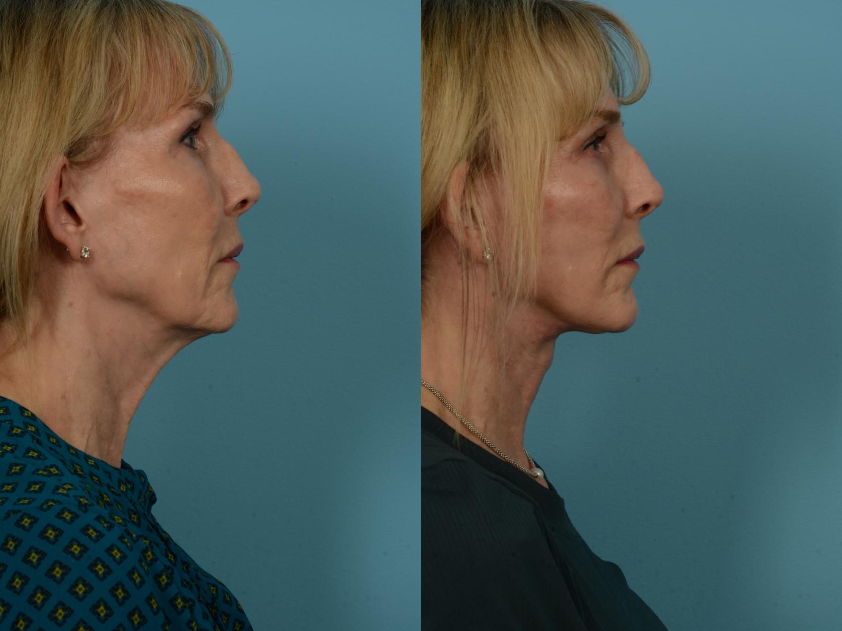 Before & After Dual Plane Facelift by Dr. Sinno Case 1137 Right Side View in Chicago, IL