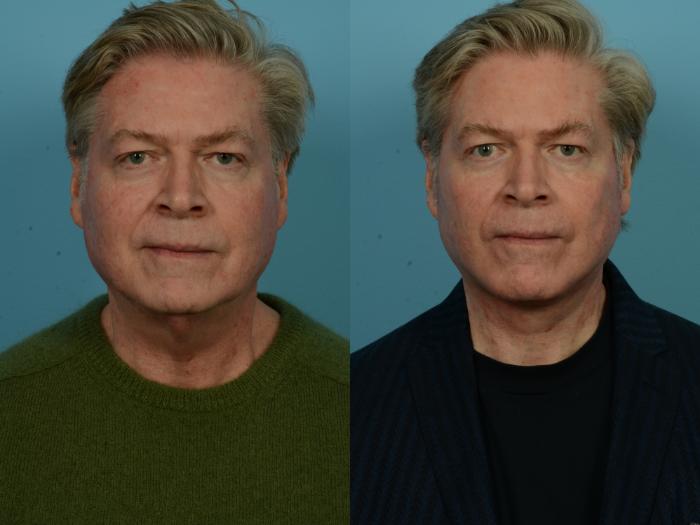 Before & After Dual Plane Facelift by Dr. Sinno Case 1142 Front View in Chicago, IL