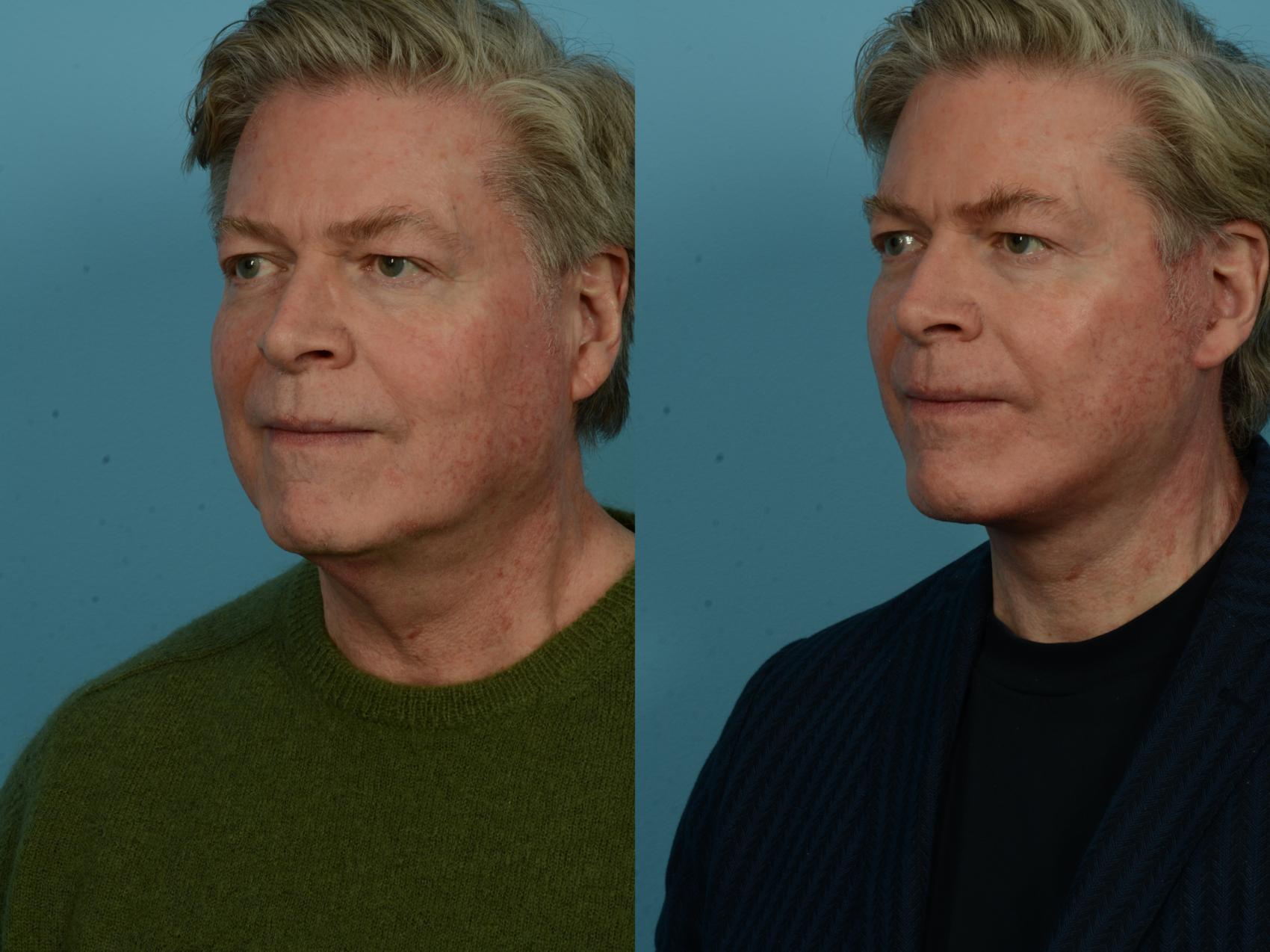 Before & After Dual Plane Facelift by Dr. Sinno Case 1142 Left Oblique View in Chicago, IL