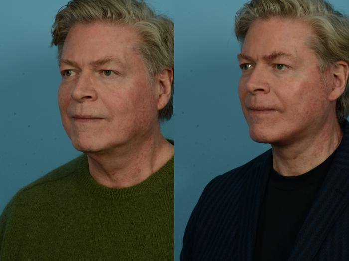 Before & After Dual Plane Facelift by Dr. Sinno Case 1142 Left Oblique View in Chicago, IL