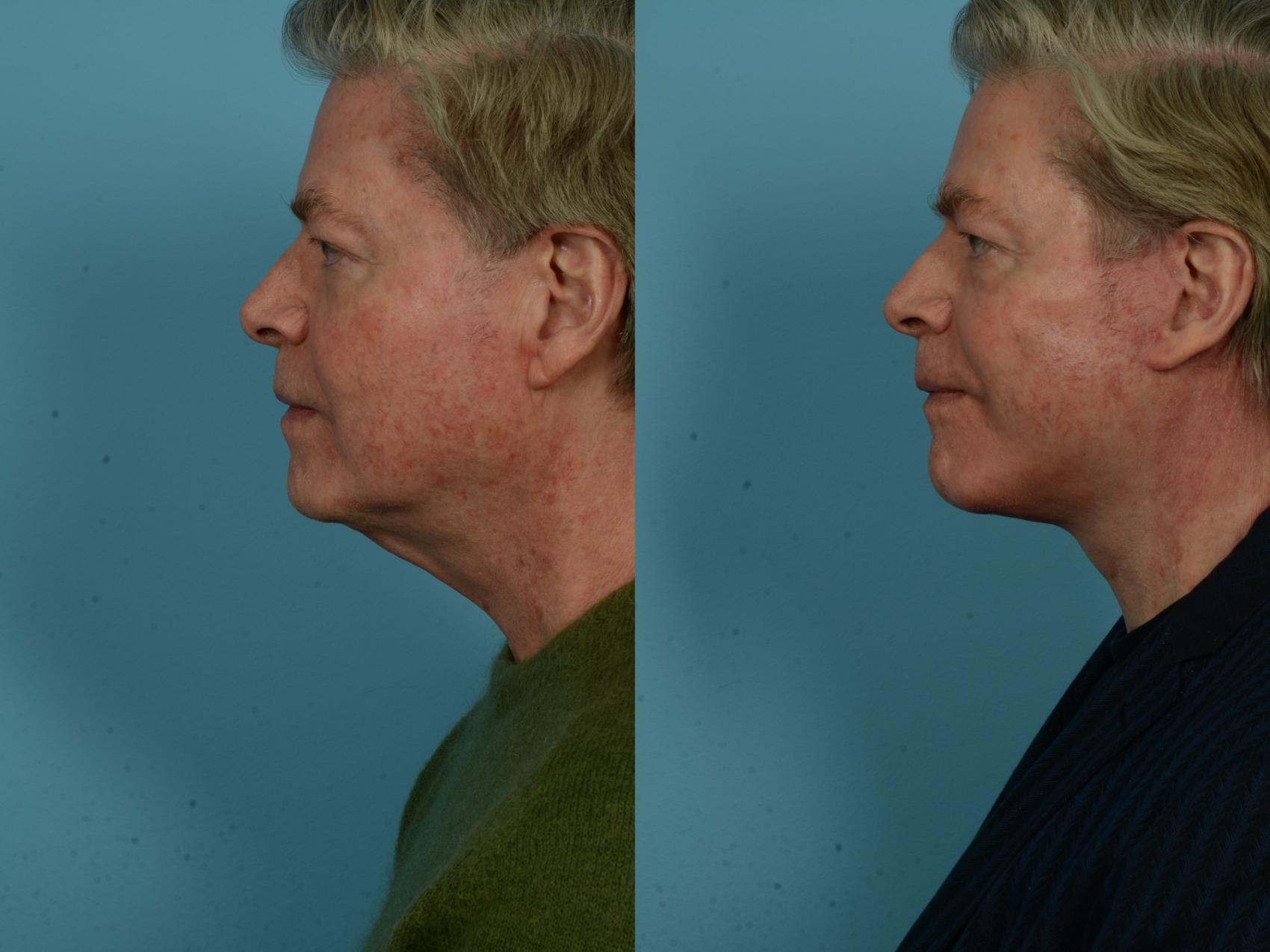 Before & After Dual Plane Facelift by Dr. Sinno Case 1142 Left Side View in Chicago, IL