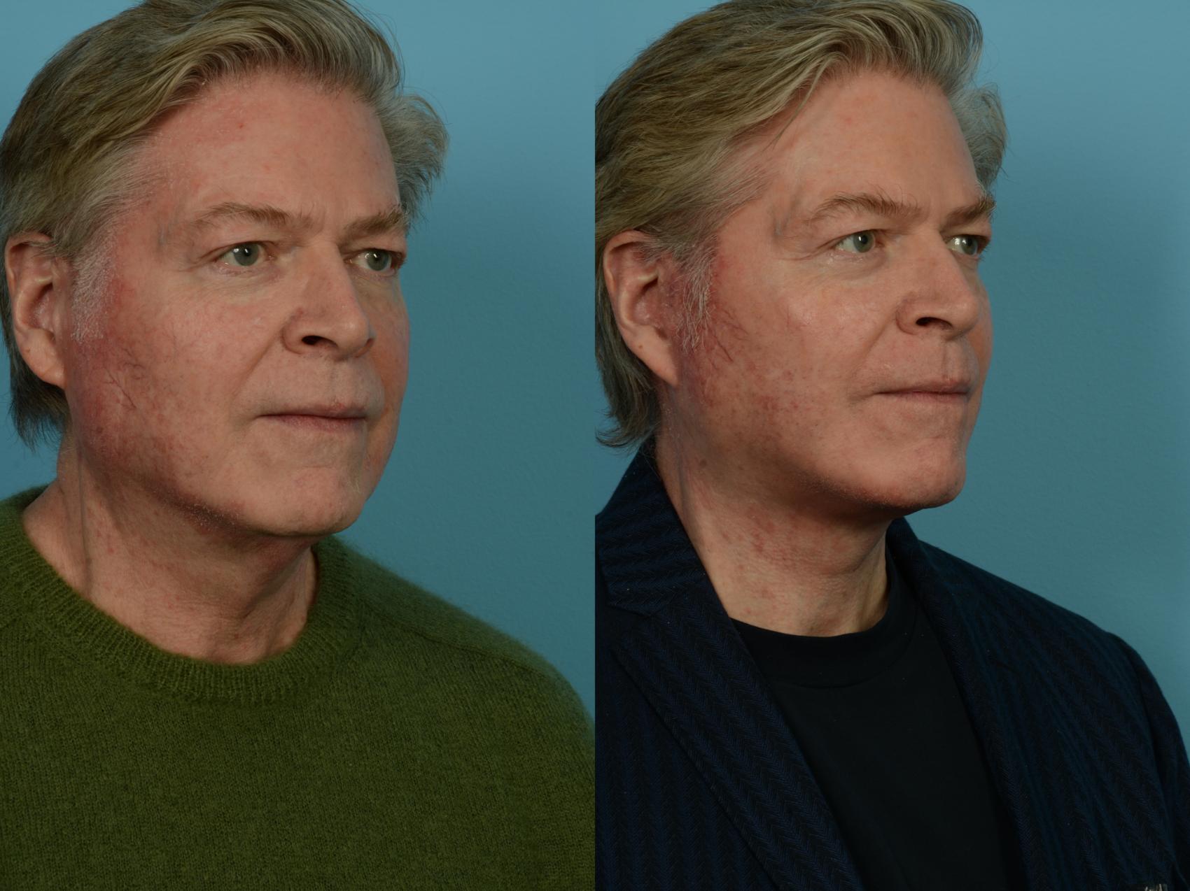 Before & After Dual Plane Facelift by Dr. Sinno Case 1142 Right Oblique View in Chicago, IL
