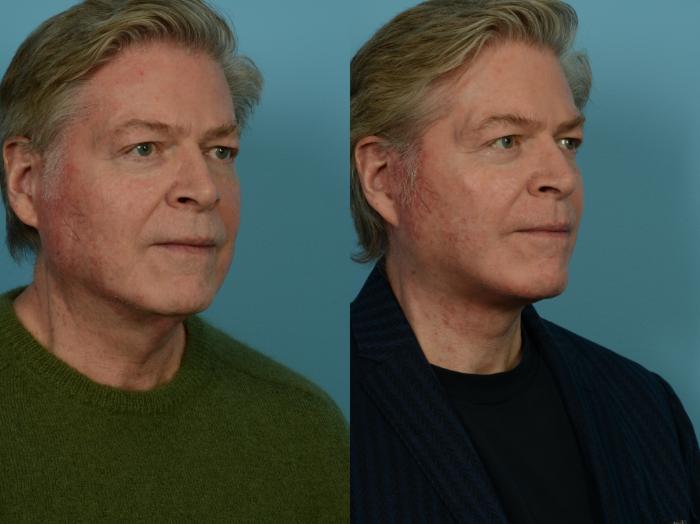 Before & After Dual Plane Facelift by Dr. Sinno Case 1142 Right Oblique View in Chicago, IL