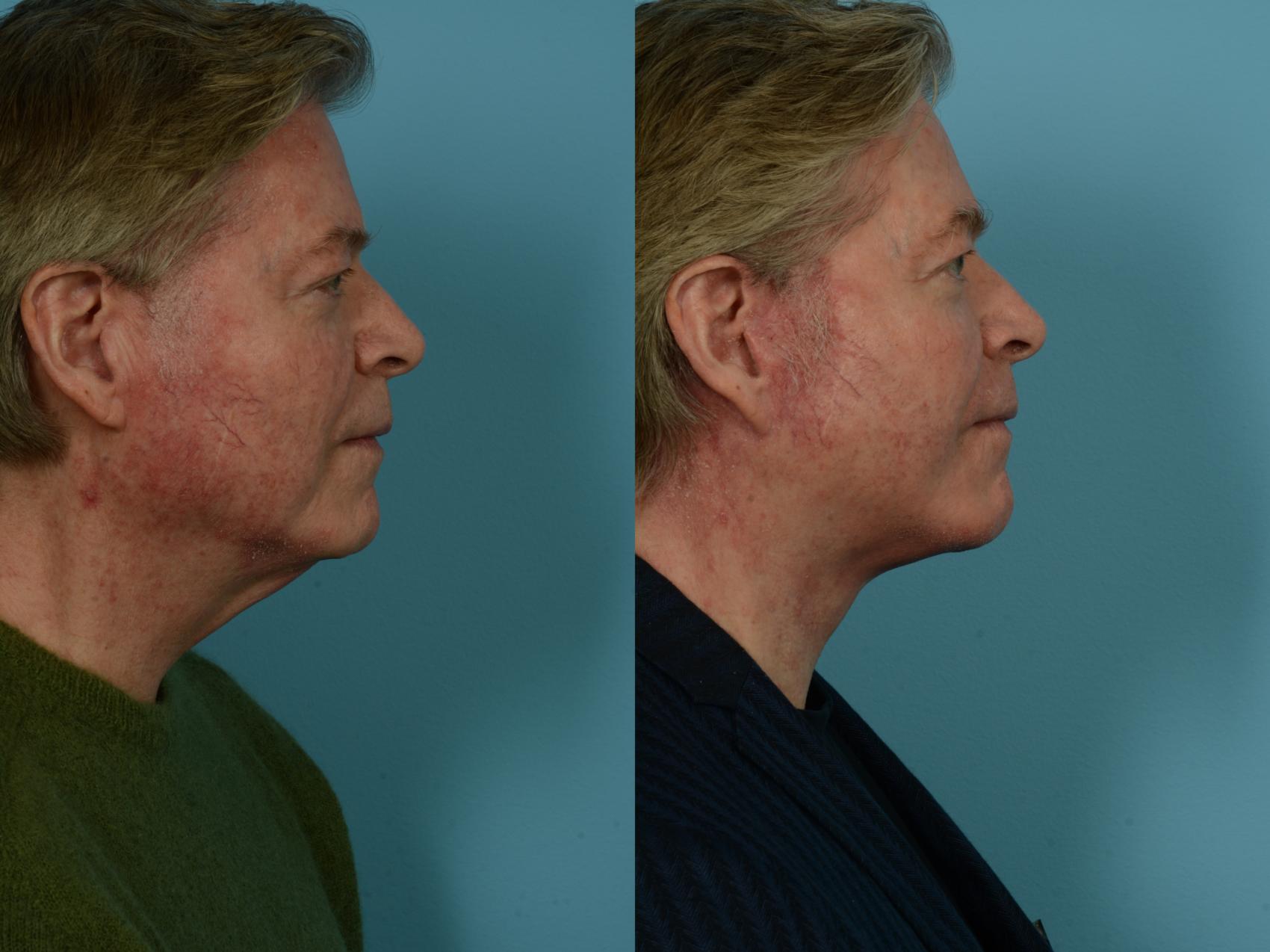 Before & After Dual Plane Facelift by Dr. Sinno Case 1142 Right Side View in Chicago, IL