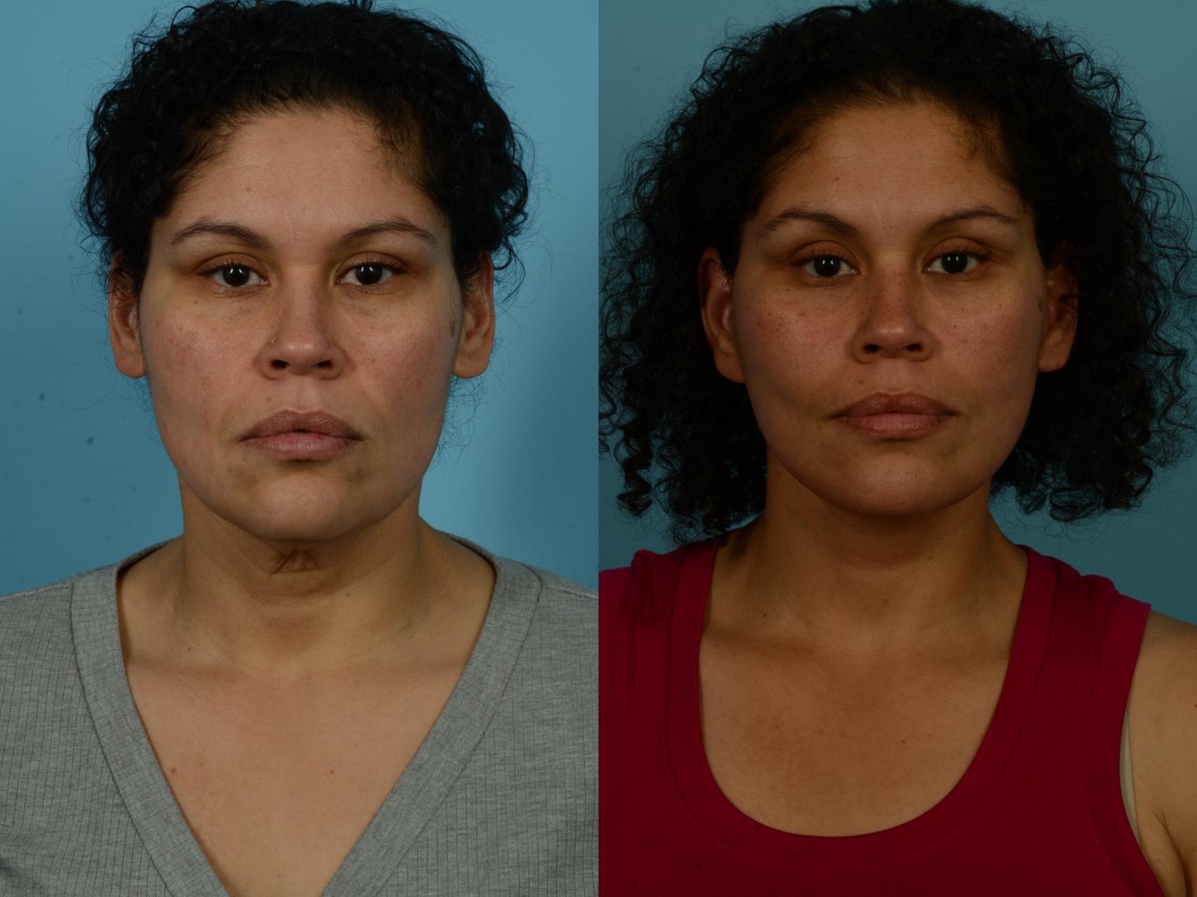 Before & After Dual Plane Facelift by Dr. Sinno Case 1154 Front View in Chicago, IL