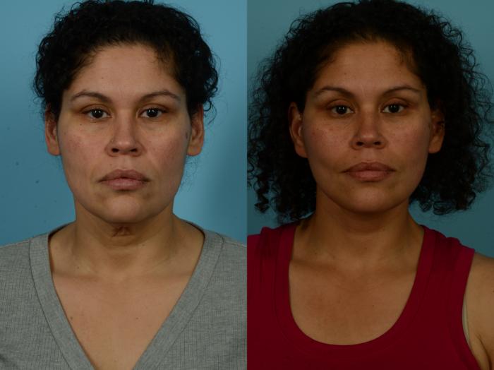 Before & After Dual Plane Facelift by Dr. Sinno Case 1154 Front View in Chicago, IL