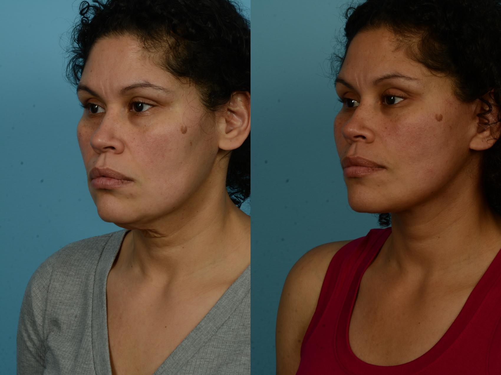 Before & After Dual Plane Facelift by Dr. Sinno Case 1154 Left Oblique View in Chicago, IL