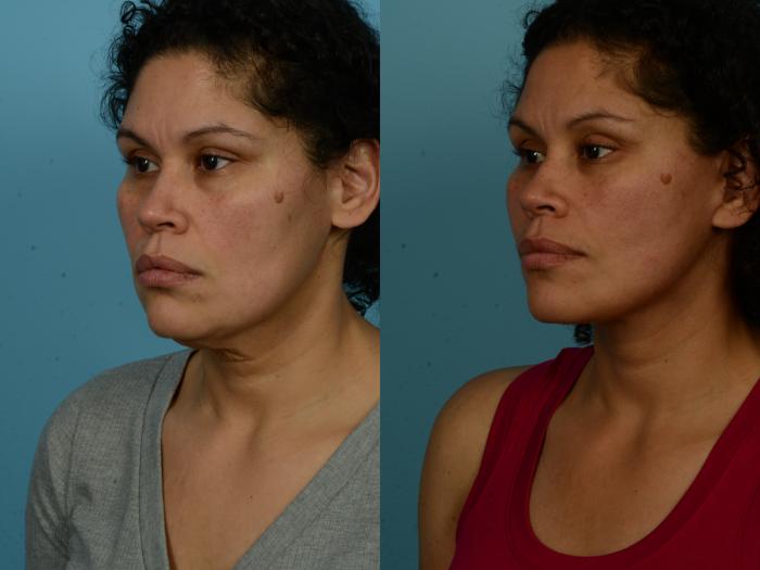 Before & After Dual Plane Facelift by Dr. Sinno Case 1154 Left Oblique View in Chicago, IL