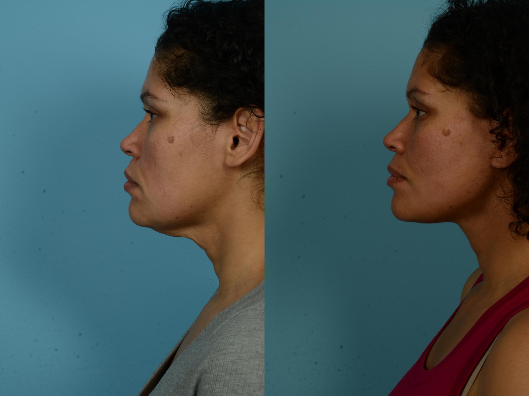 Before & After Dual Plane Facelift by Dr. Sinno Case 1154 Left Side View in Chicago, IL