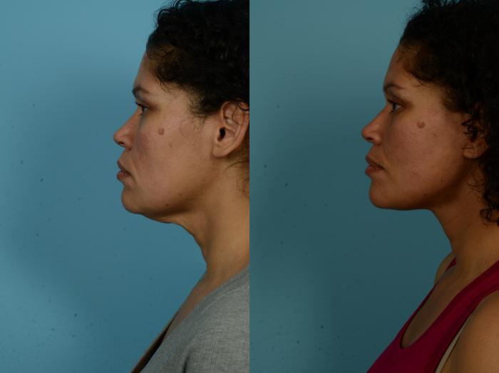 Before & After Dual Plane Facelift by Dr. Sinno Case 1154 Left Side View in Chicago, IL