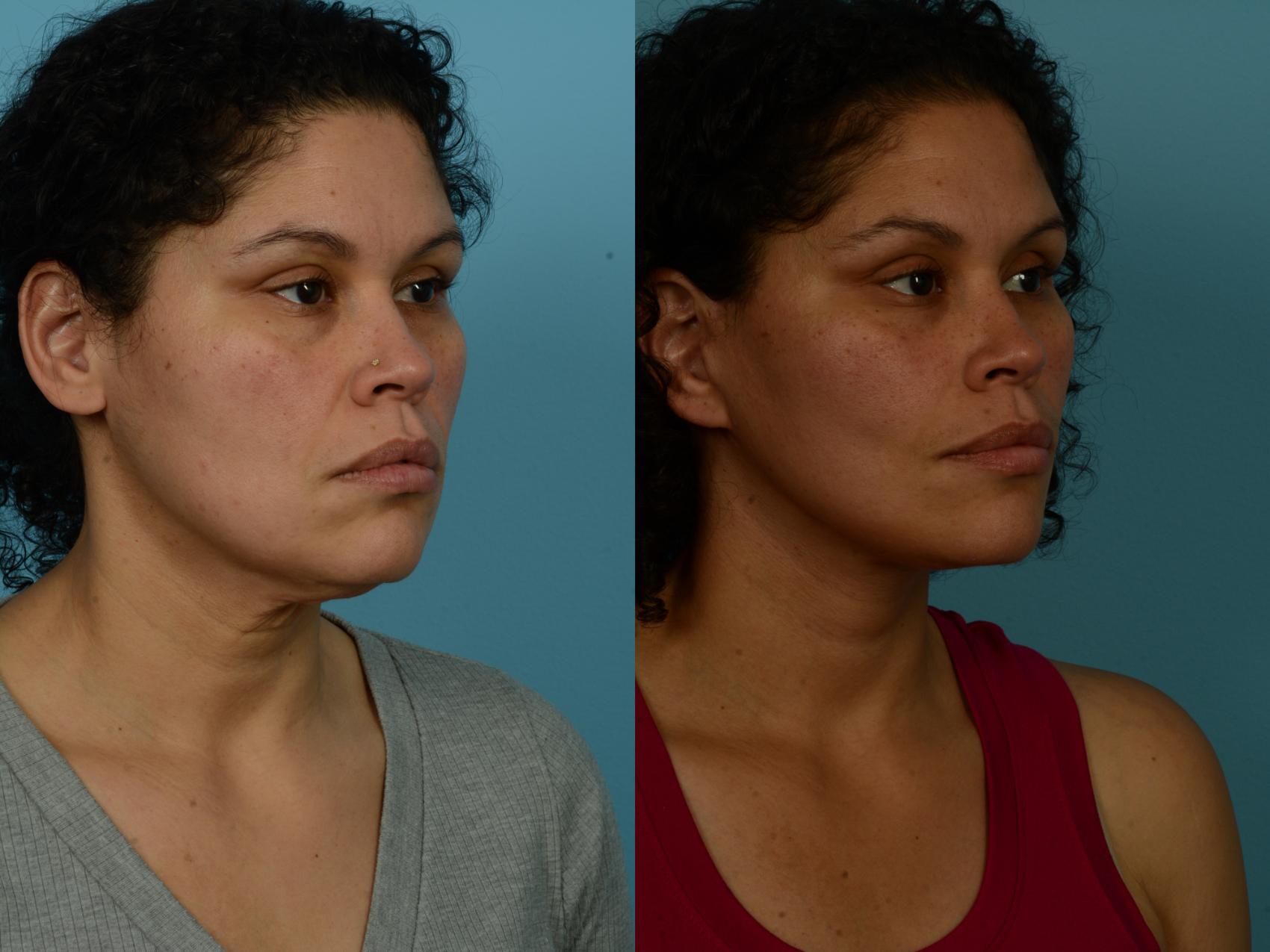 Before & After Dual Plane Facelift by Dr. Sinno Case 1154 Right Oblique View in Chicago, IL