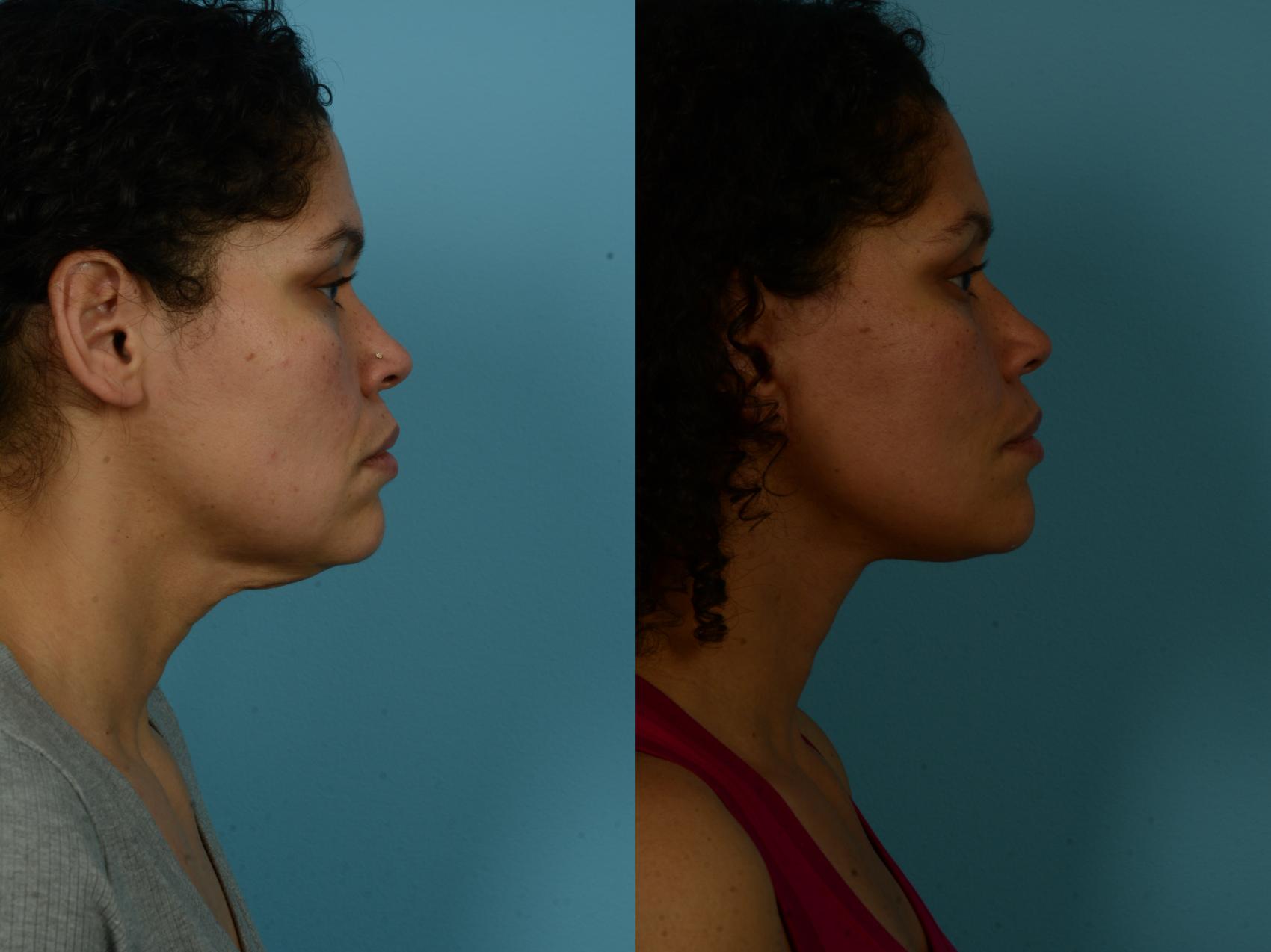 Before & After Dual Plane Facelift by Dr. Sinno Case 1154 Right Side View in Chicago, IL