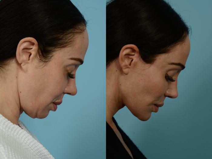 Before & After Dual Plane Facelift by Dr. Sinno Case 741 Connell View View in Chicago, IL