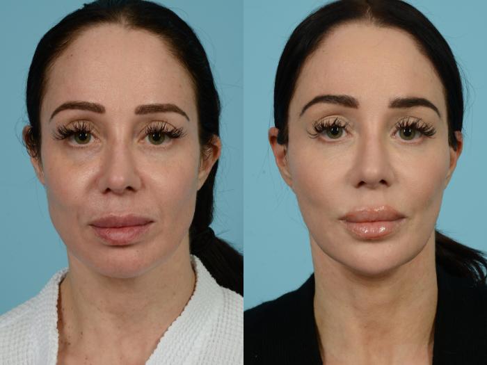 Before & After Dual Plane Facelift by Dr. Sinno Case 741 Front View in Chicago, IL