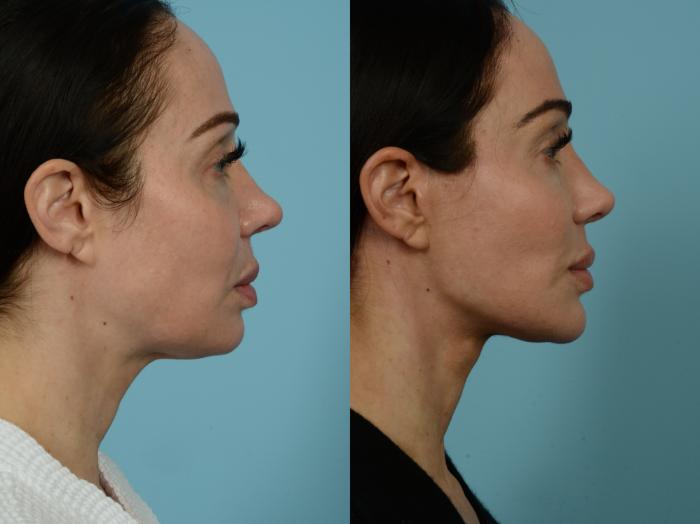 Before & After Dual Plane Facelift by Dr. Sinno Case 741 Right Side View in Chicago, IL
