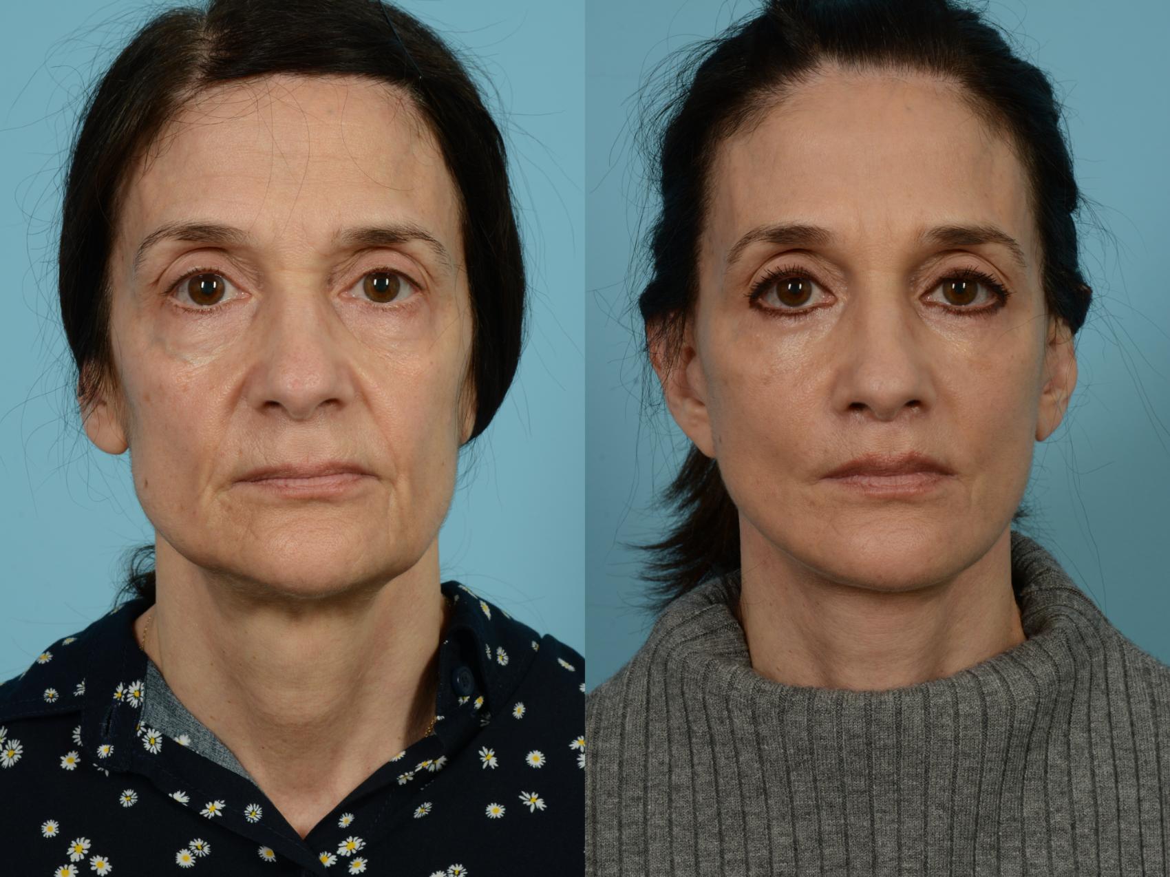 Before & After Dual Plane Facelift by Dr. Sinno Case 803 Front View in Chicago, IL