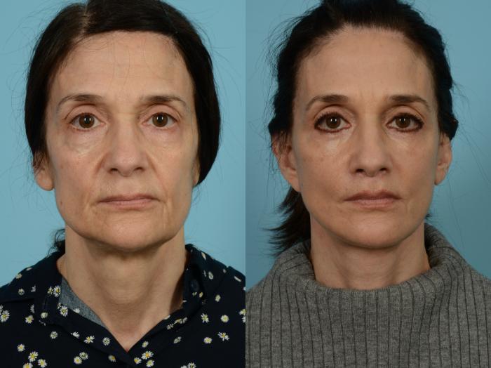 Before & After Dual Plane Facelift by Dr. Sinno Case 803 Front View in Chicago, IL