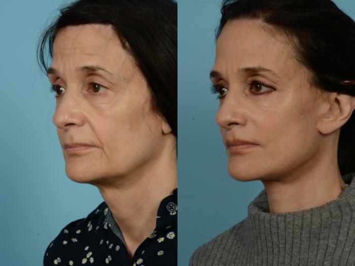 Before & After Dual Plane Facelift by Dr. Sinno Case 803 Left Oblique View in Chicago, IL