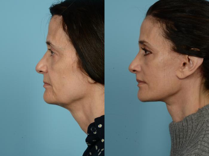 Before & After Dual Plane Facelift by Dr. Sinno Case 803 Left Side View in Chicago, IL