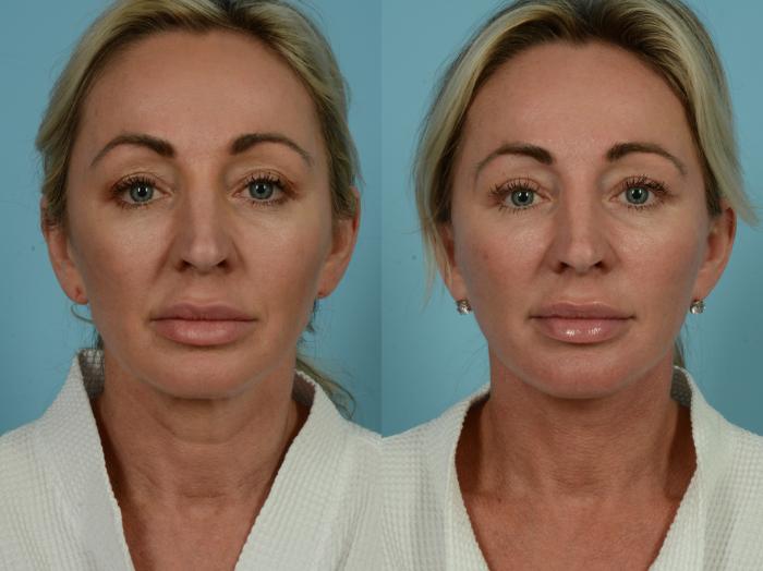 Before & After Dual Plane Facelift by Dr. Sinno Case 844 Front View in Chicago, IL