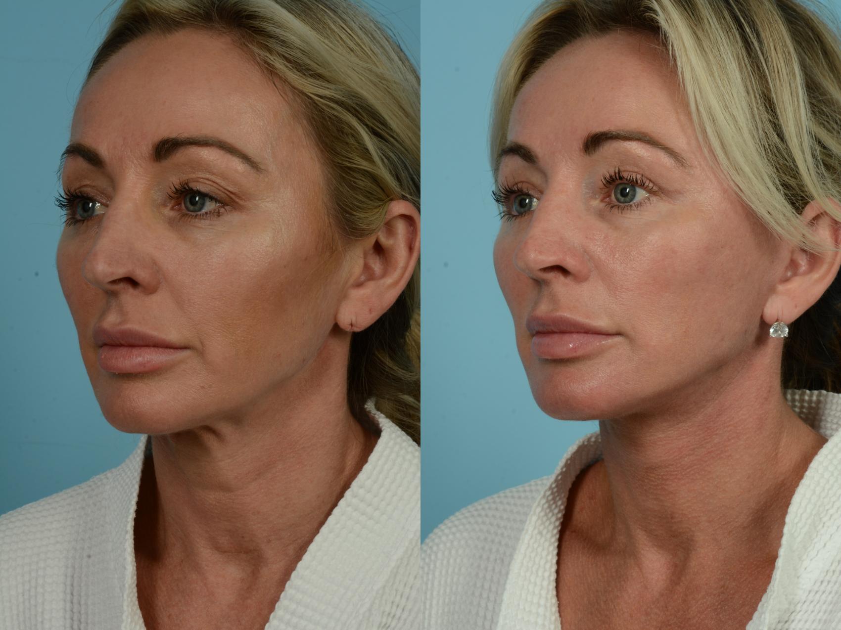 Before & After Dual Plane Facelift by Dr. Sinno Case 844 Left Oblique View in Chicago, IL