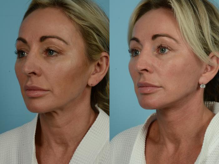 Before & After Dual Plane Facelift by Dr. Sinno Case 844 Left Oblique View in Chicago, IL