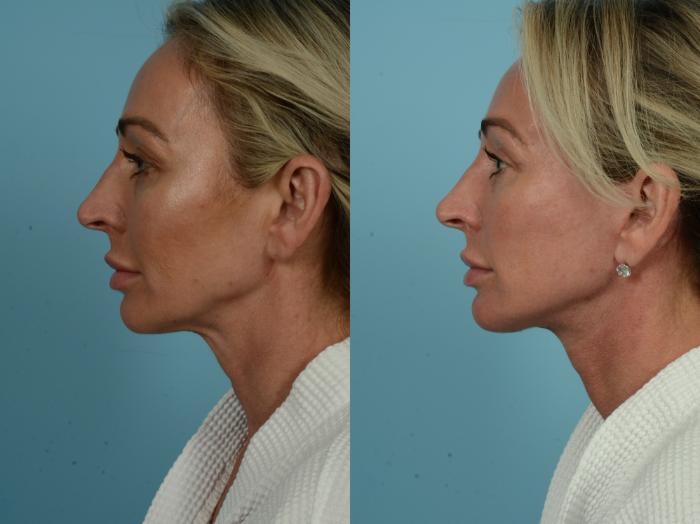 Before & After Dual Plane Facelift by Dr. Sinno Case 844 Left Side View in Chicago, IL