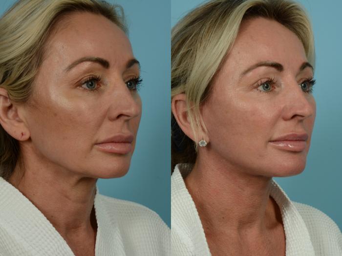 Before & After Dual Plane Facelift by Dr. Sinno Case 844 Right Oblique View in Chicago, IL