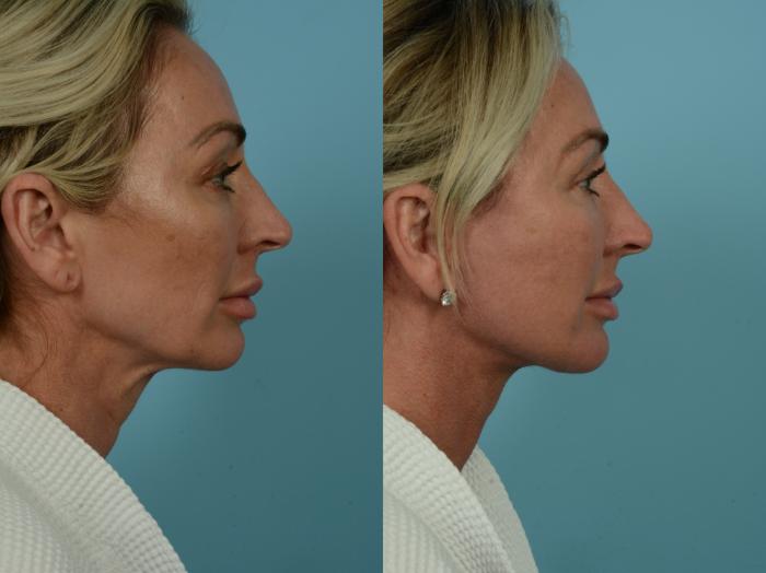 Before & After Dual Plane Facelift by Dr. Sinno Case 844 Right Side View in Chicago, IL