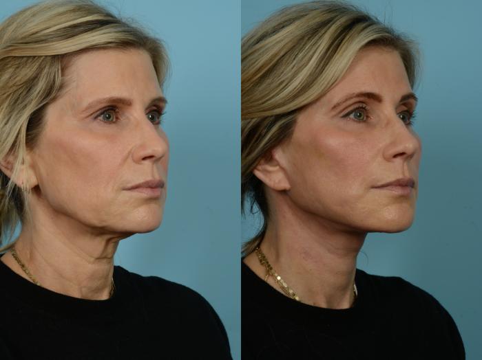 Before & After Dual Plane Facelift by Dr. Sinno Case 848 Right Oblique View in Chicago, IL