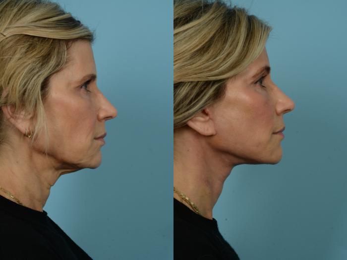 Before & After Dual Plane Facelift by Dr. Sinno Case 848 Right Side View in Chicago, IL