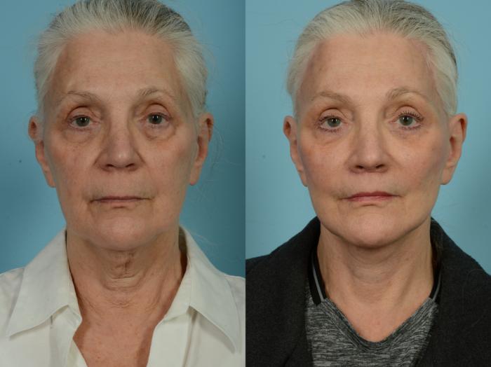Before & After Dual Plane Facelift by Dr. Sinno Case 850 Front View in Chicago, IL