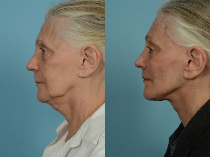 Before & After Dual Plane Facelift by Dr. Sinno Case 850 Left Side View in Chicago, IL