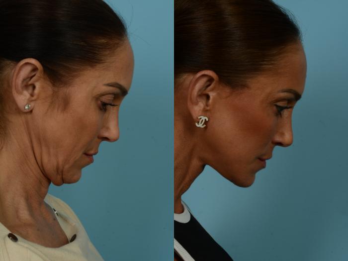 Before & After Dual Plane Facelift by Dr. Sinno Case 860 Connell View View in Chicago, IL